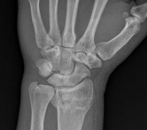 AP view of the distal radius demonstrates a comminuted, mildly displaced, intra-articular fracture of the distal radius as diagnosed by a DACBR Chiropractic Radiologist at Kinetic Radiology