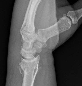 Lateral view of the distal radius demonstrates a comminuted, mildly displaced, intra-articular fracture of the distal radius as diagnosed by a DACBR Chiropractic Radiologist at Kinetic Radiology