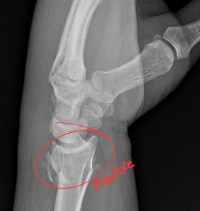 Annotated lateral view of the distal radius demonstrates a comminuted, mildly displaced, intra-articular fracture of the distal radius as diagnosed by a DACBR Chiropractic Radiologist at Kinetic Radiology