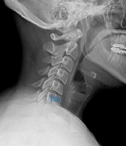 DACBR-Diagnostic-Imaging-Consultants- Hemangioma-Annotated