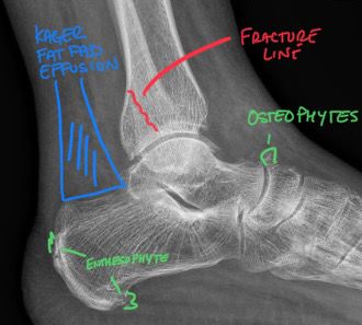DACBR vs Chiropractor: Subtle lateral malleolar fracture