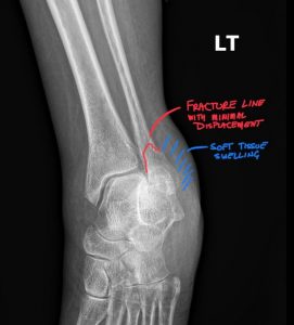 DACBR vs Chiropractor: Subtle lateral malleolar fracture