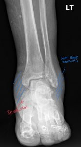 Charcot arthropathy: Professional Imaging Consultants Guide to Joint Destruction