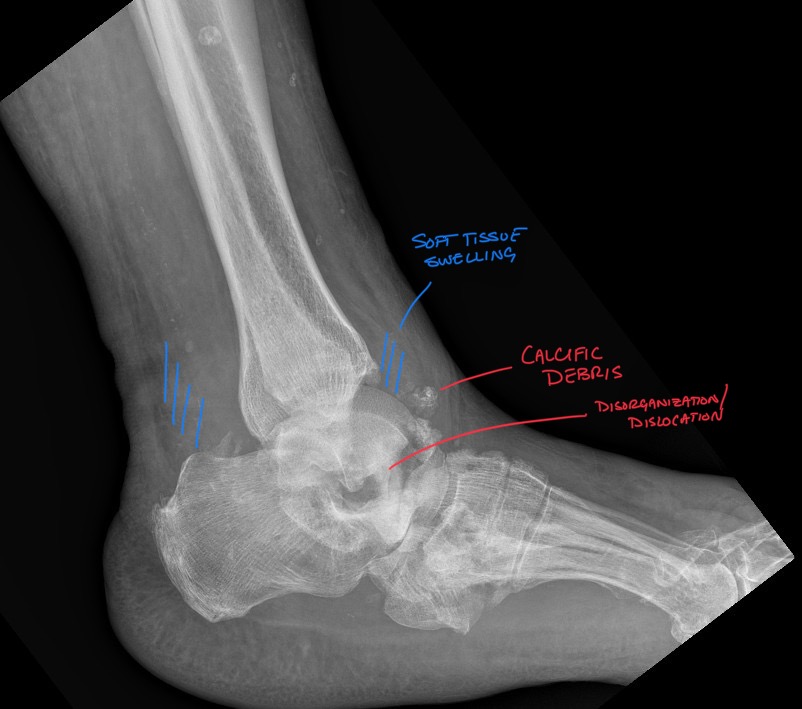 Charcot arthropathy: Professional Imaging Consultants Guide to Joint Destruction