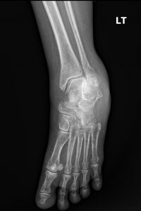 DACBR vs Chiropractor: Subtle lateral malleolar fracture