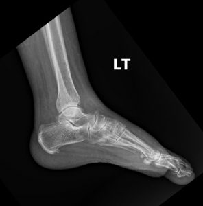 DACBR vs Chiropractor: Subtle lateral malleolar fracture