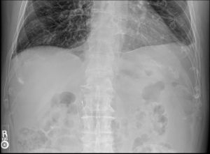 Kidney Stones: A DACBR Radiology Perspective on X-Ray and Ultrasound Imaging