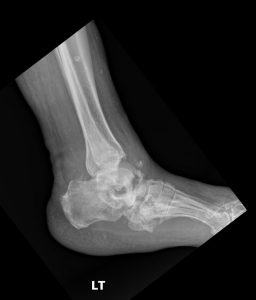 Charcot arthropathy: Professional Imaging Consultants Guide to Joint Destruction