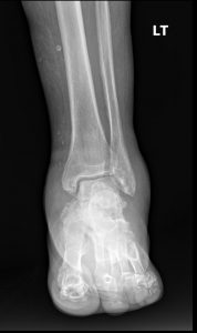 Charcot arthropathy: Professional Imaging Consultants Guide to Joint Destruction