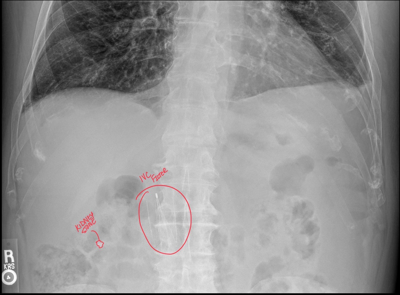 Kidney Stones: A DACBR Radiology Perspective on X-Ray and Ultrasound Imaging