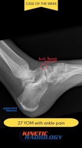 Ankle Sprain Needs a Second Look from Your DACBR or Diagnostic Imaging Consultant