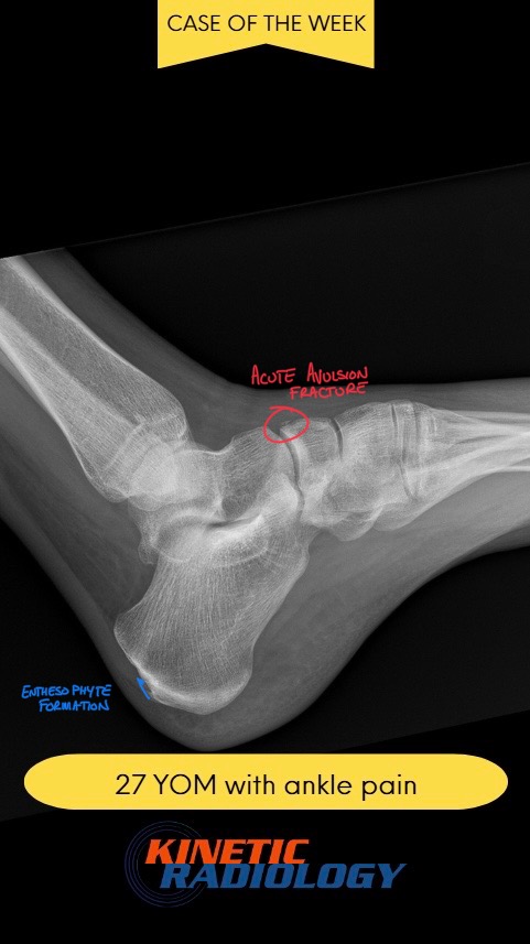 Ankle Sprain Needs a Second Look from Your DACBR or Diagnostic Imaging Consultant