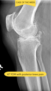 Osteochondromatosis: A Comprehensive Guide for Healthcare Providers