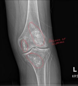 Bone Infarctions: A Comprehensive Guide to Diagnosis and Differential Considerations