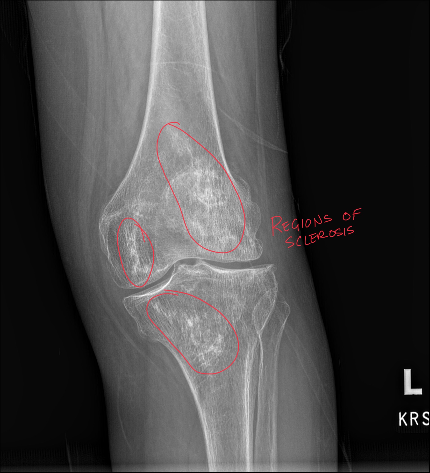 Bone Infarctions: A Comprehensive Guide to Diagnosis and Differential Considerations