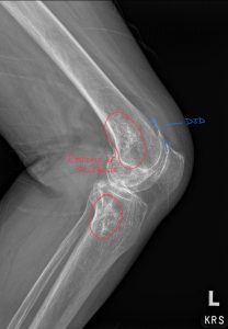 Bone Infarctions: A Comprehensive Guide to Diagnosis and Differential Considerations