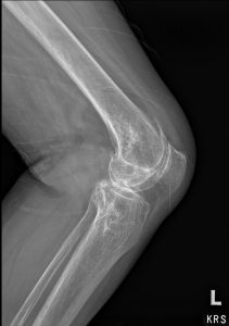 Bone Infarctions: A Comprehensive Guide to Diagnosis and Differential Considerations