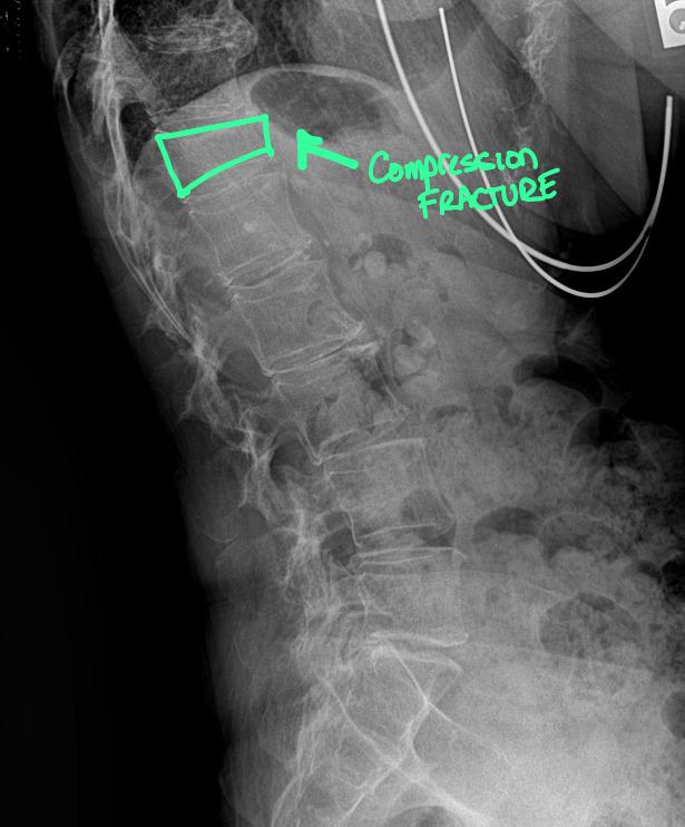 Compression Fracture: Radiology for Chiropractors, Imaging Centers, and Legal Teams
