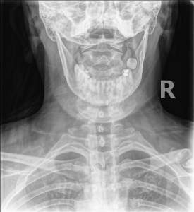 DACBRs Diagnose a Chronic Clavicle Fracture