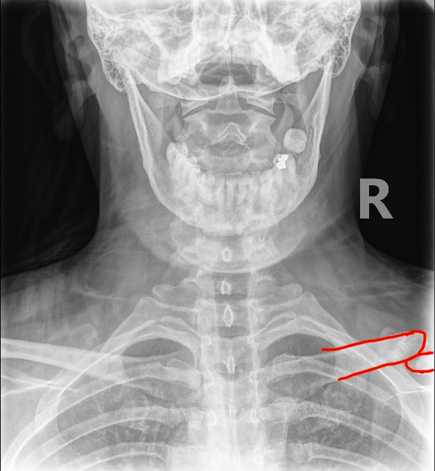 DACBRs Diagnose a Chronic Clavicle Fracture