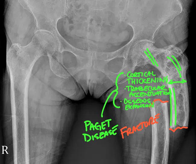 Paget Disease of Bone: A Comprehensive Guide for Chiropractors, Primary Care Providers, and Urgent Care Centers