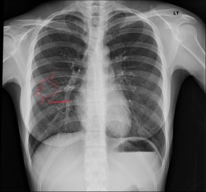DACBR Report: Second Opinion on Right Mid-Lung Field Pneumonia in a 30-Year-Old Female with Cough