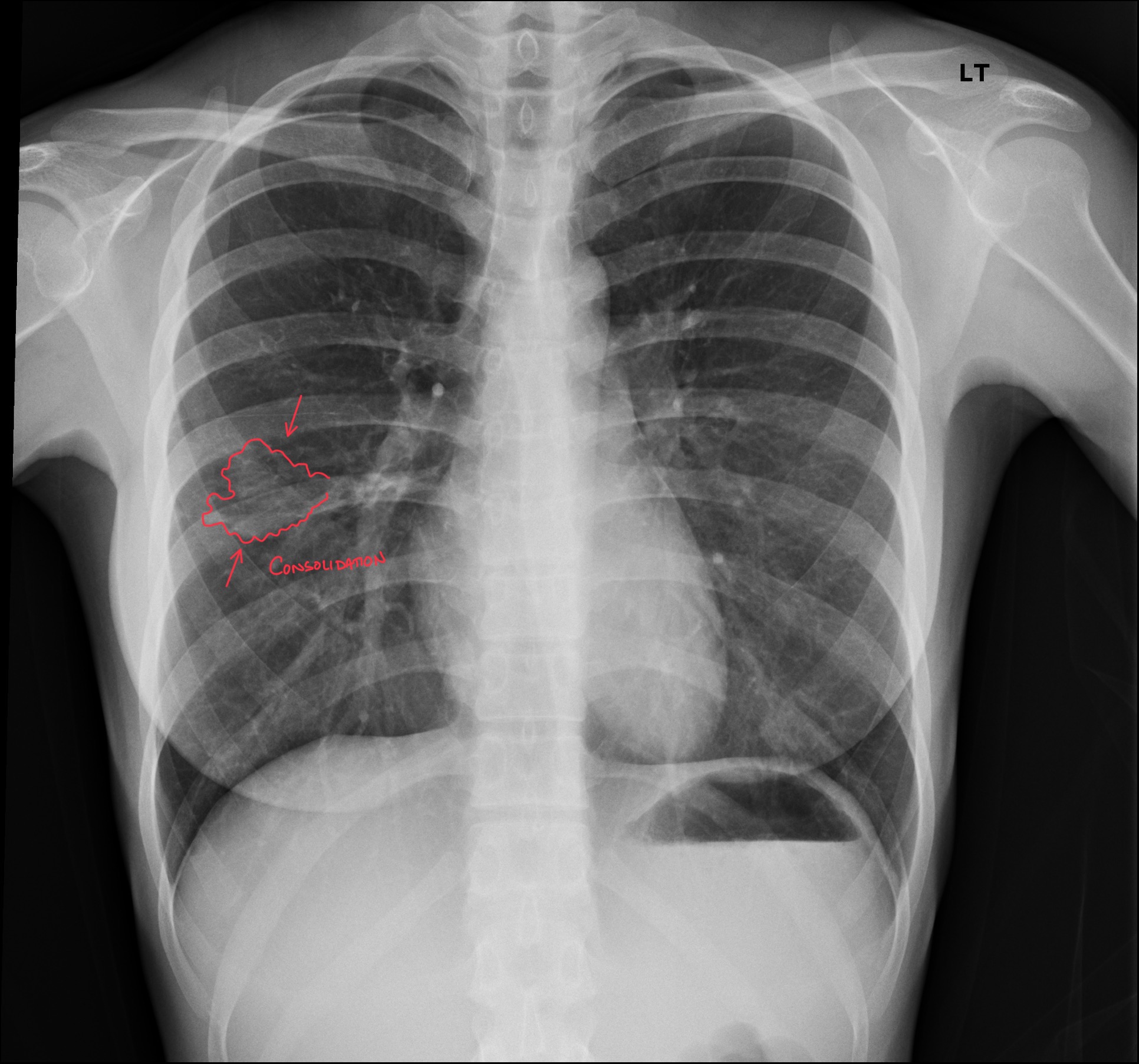DACBR Report: Second Opinion on Right Mid-Lung Field Pneumonia in a 30-Year-Old Female with Cough