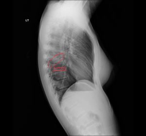 DACBR Report: Second Opinion on Right Mid-Lung Field Pneumonia in a 30-Year-Old Female with Cough