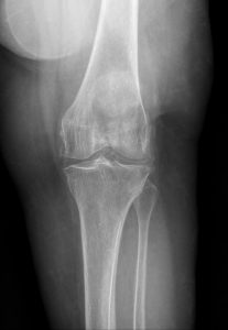 Chondrocalcinosis and CPPD: A Diagnostic Imaging Guide for Chiropractors, Primary Care, and Urgent Care