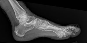 Second Metatarsal Stress Fracture: Diagnostic Imaging Consultants Guide to X-ray and MRI Findings