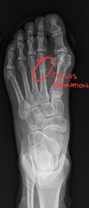 Second Metatarsal Stress Fracture: Diagnostic Imaging Consultants Guide to X-ray and MRI Findings