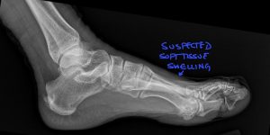 Second Metatarsal Stress Fracture: Diagnostic Imaging Consultants Guide to X-ray and MRI Findings