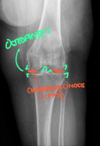 Chondrocalcinosis and CPPD: Kinetic Radiology