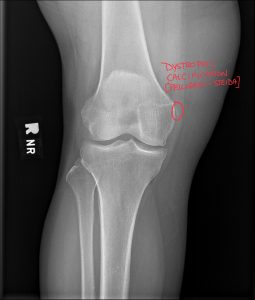 Pellegrini Stieda Annotated Kinetic Radiology