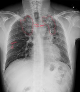 DACBR Report: Second Opinion on Upper Lung Fibrosis in Pulmonary Tuberculosis
