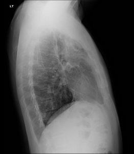 DACBR Report: Second Opinion on Upper Lung Fibrosis in Pulmonary Tuberculosis