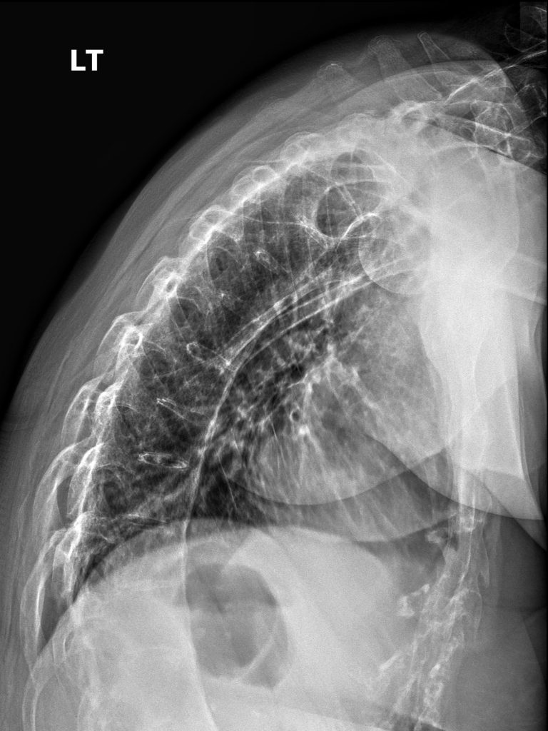 Unannotated — Recognizing Advanced Ankylosing Spondylitis: Chiropractors Guide by a Radiologist (DACBR)