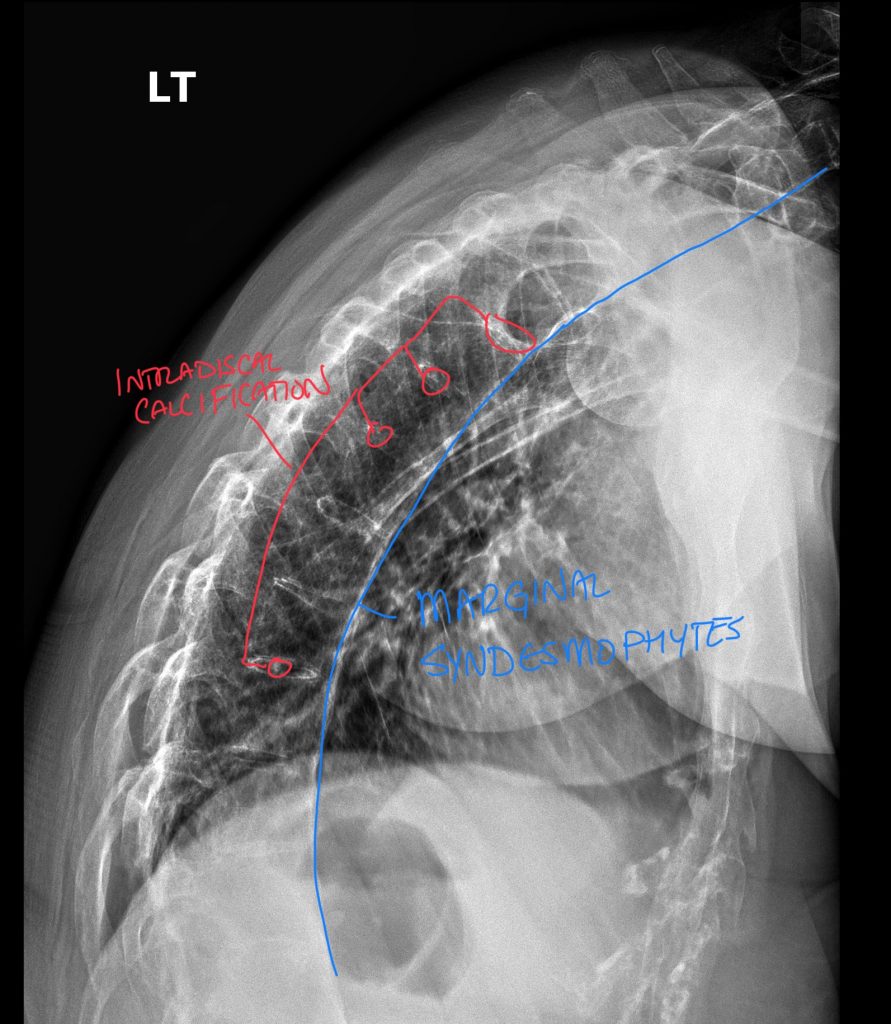 Annotated — Recognizing Advanced Ankylosing Spondylitis: Chiropractors Guide by a Radiologist (DACBR)